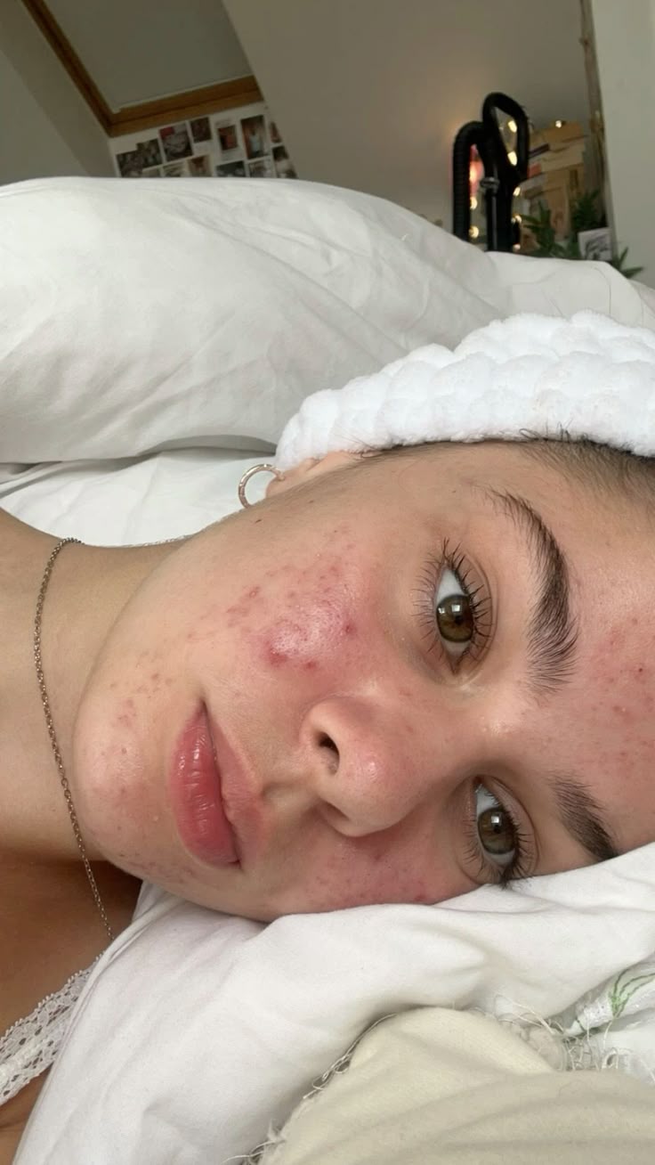 Skincare Routine That Works for Hormonal Acne 🌿